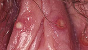 HSV-2 – Female Genital Labial Folds