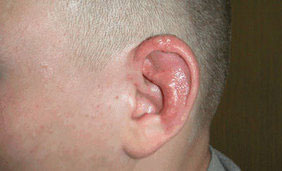HSV-1 Ear